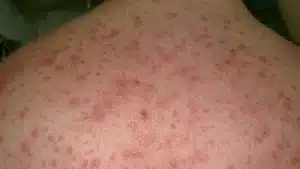 نکرولیز اپیدرمی سمی یکی از عوارض جانبی مهم تگرتول است.