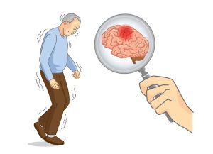 اولین علائم پارکینسون